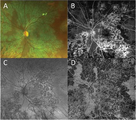 Multimodal Widefield Imaging Of Active Tb Associated Multifocal