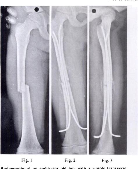 Pdf Elastic Stable Intramedullary Nailing Of Femoral Shaft Fractures