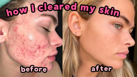 My Accutane Experience How I Cleared My Severe Acne Q A With Lots