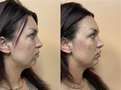 Fillers Gallery Dr Paul Vanek Md