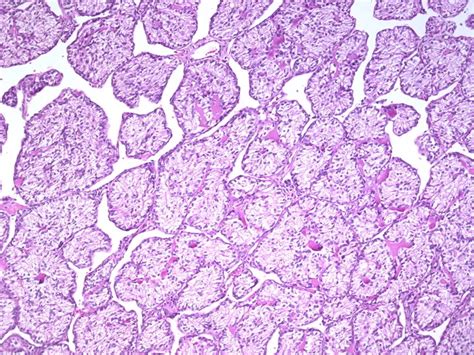 Sex Cord Tumor With Annular Tubules