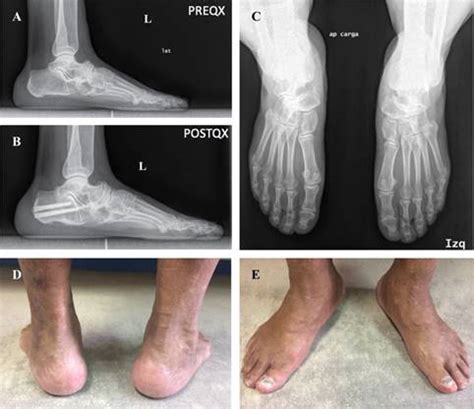 Osteotomía lateral de calcáneo en el tratamiento de la enfermedad de