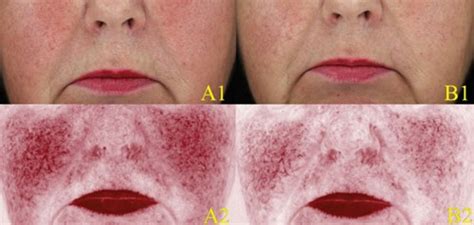 Using Erythema Directed Digital Photography In Patients With Rosacea