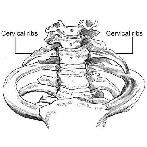 What Are Cervical Ribs Are They Dangerous