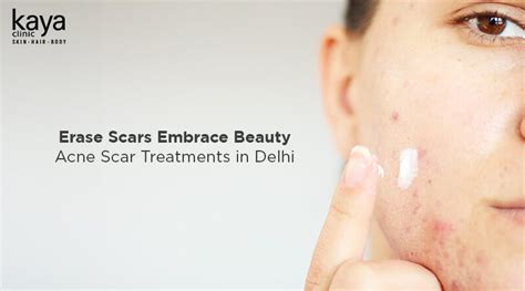 Acne Scar Treatment In Delhi Cost And Process Blog