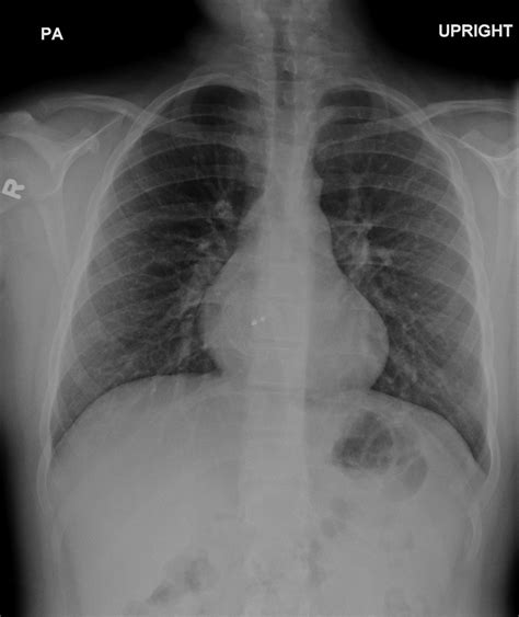 Amplatzer Septal Occluder For Secundum Asd Radiology Case