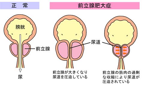 診療案内 前立腺肥大症｜ 姫路市の泌尿器科 まつばらクリニック泌尿器科