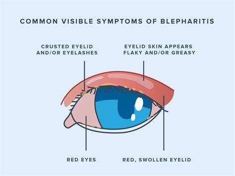 Ulcerative Blepharitis Right Lower Eyelid Histological specimens of ...