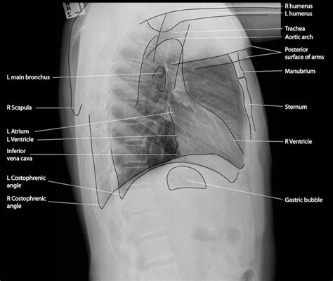 Interpreting A Chest X Ray Stepwards