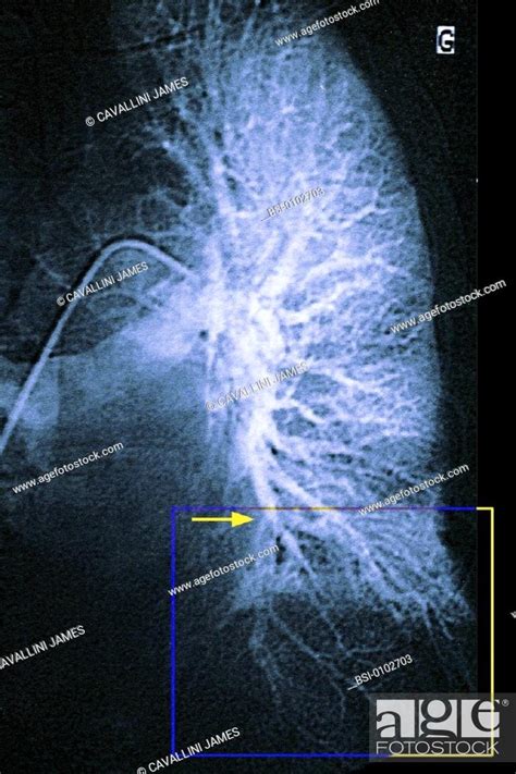 PULMONARY INFARCTION ANGIOGRAPHY Infarction at the level of the left ...