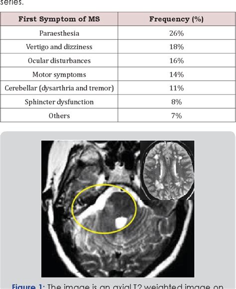 Figure 1 From Multiple Sclerosis And Trigeminal Neuralgia A Well Noted