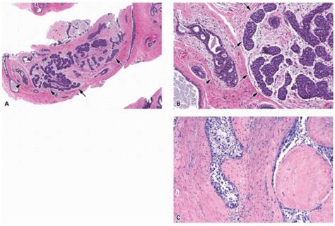 Fibroepithelial Neoplasms Basicmedical Key