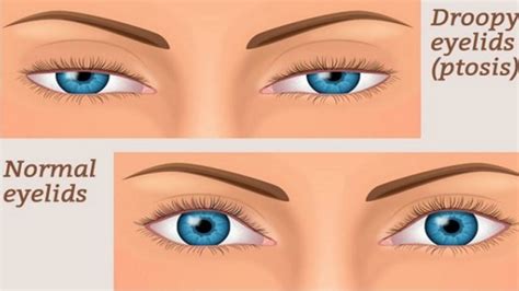 How To Fix Your Droopy Eyelids Ptosis Medisettermedisetter