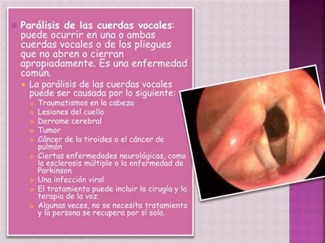 Ppt Las Cuerdas Vocales Powerpoint Presentation Id4869625