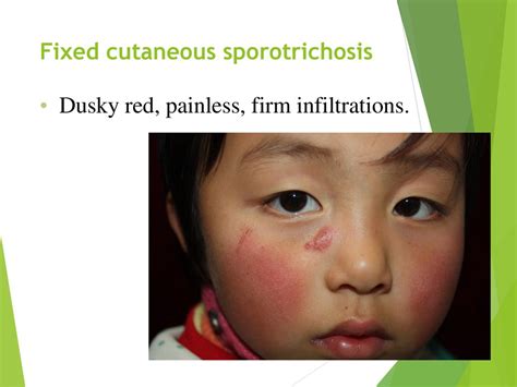 Infective Dermatoses ——fungal Infections Ppt Download