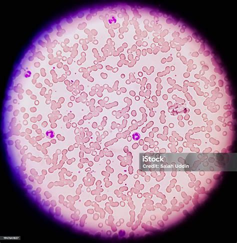 A Peripheral Blood Smear And Hypersegmented Neutrophil Were Seen Stock