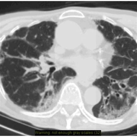 High Resolution Computed Tomography Of The Chest Showing Extensive Download Scientific Diagram