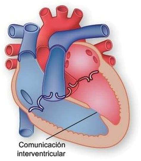 Etiologia ComunicaciÓn Interventricular