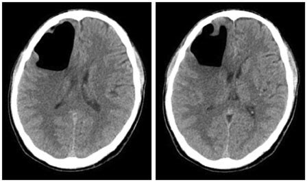 Proper Management Of Posttraumatic Tension Pneumocephalus