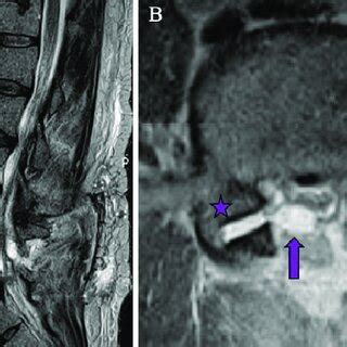 Central Sagittal A And Axial B T2 Weighted MRI Of The Lumbar Spine