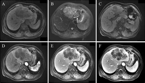 Frontiers Mri Features Of Hepatic Sarcomatoid Carcinoma Different