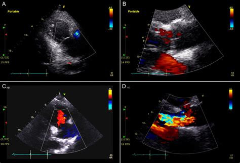 Echocardiograms Performed At The Time Of Aorta Injury And Months