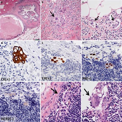 Patient 4 With Minimal Tumor Volume In Sentinel Lymph Node Isolated Download Scientific