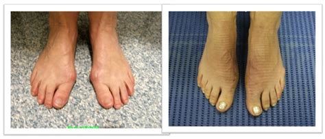 Hallux Limitus Rigidus Sydney Big Toe Arthritis Treatment Sydney Nsw