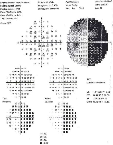 Humphrey Visual Field Test Shows Right Homonymous Hemianopia And Left Download Scientific