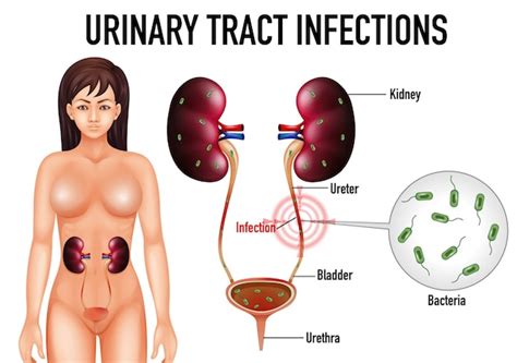 Ilustración Informativa De Infecciones Del Tracto Urinario Vector Gratis