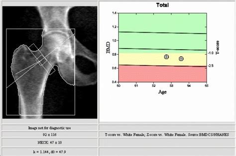 Understanding Your Bone Density Scan Results