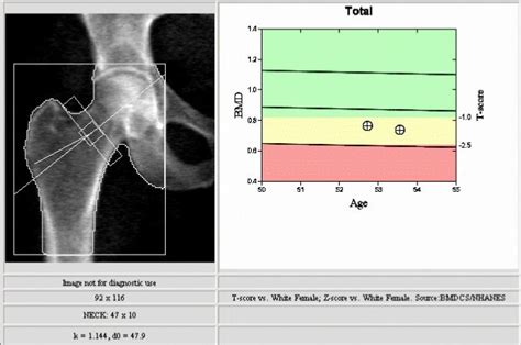 Understanding Your Bone Density Scan Results