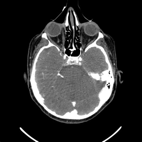 Acute Basilar Artery Occlusion Image