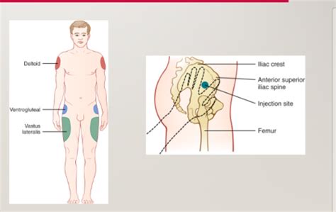 PA Clin Procedures Injections Flashcards Quizlet