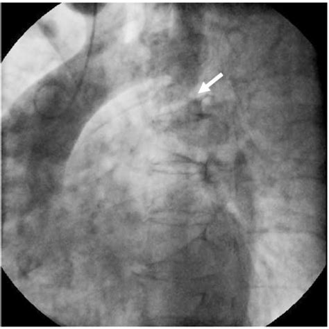 Aortography Revealed Severe Coarctation Of The Aorta Arrow Download Scientific Diagram