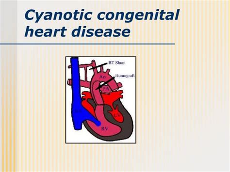 Cyanotic Congenital Heart Diseases Ppt