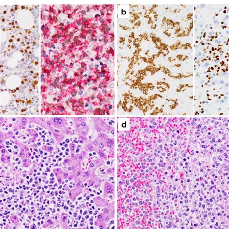 A In Situ Hybridization Of Epstein Barr Virus Encoded Rnas Ebers Download Scientific Diagram