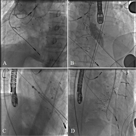 Frontiers Case Report Transapical Transcatheter Double Valve In