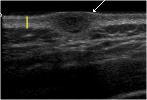 Can Ultrasound Distinguish Between Dermatofibroma And Subcutaneous