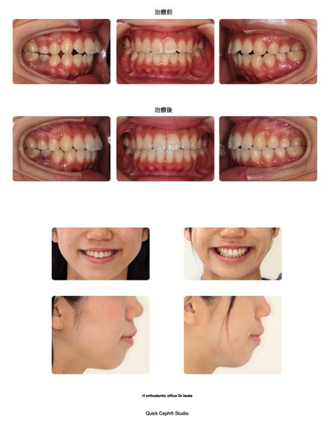 前歯部叢生を伴う上顎前突（口元の突出）に対する非抜歯矯正治療 福岡天神矯正歯科