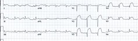 Anterior Stemi With St Elevation In I Avl V2 V6 Without Reciprocal St