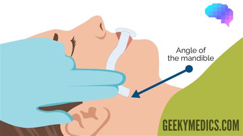 Oropharyngeal Airway (Guedel Airway) Insertion - OSCE Guide | Geeky Medics