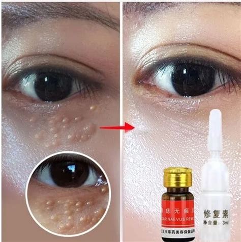 Solución indolora para eliminar lunares y pecas crema para eliminar