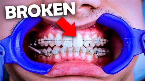 Broken Braces Brackets Coming Off What To Do Youtube