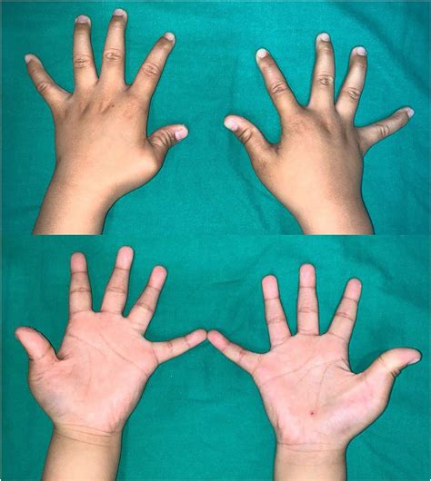 Frontiers Characteristics Of Congenital Clasped Thumb A Case Report