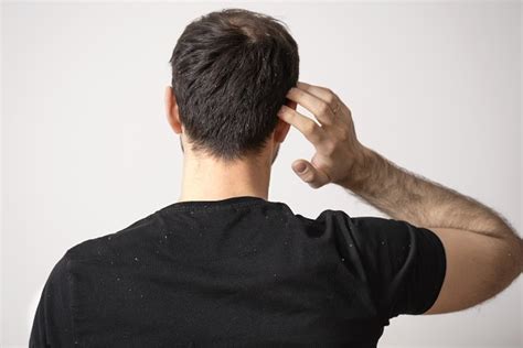 How To Treat Dandruff in Men? - MyCapil ️