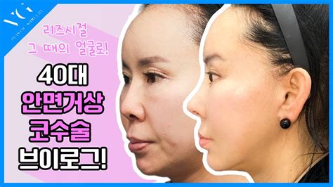 거상수술로 젊음을 되찾았어요 안면거상 이마거상 강남안면거상 Youtube