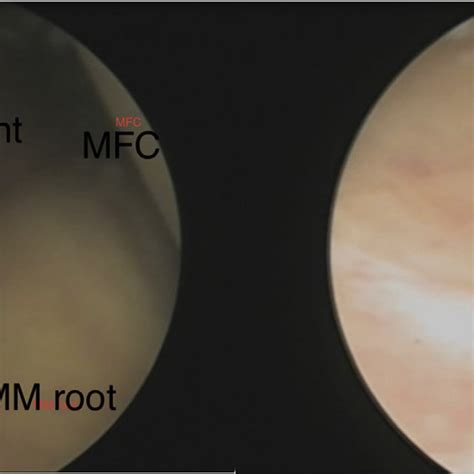 Identification Of Structures Namely The Posterior Cruciate Ligament Download Scientific