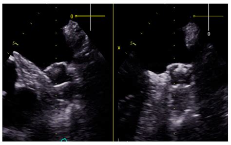 Medicina Free Full Text Percutaneous Left Atrial Appendage Closure In Patients With Non