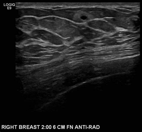 Breast Imaging Flashcards Quizlet